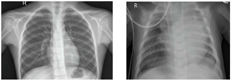 Machine learning, quantum computing can transform health care, including diagnosing pneumonia