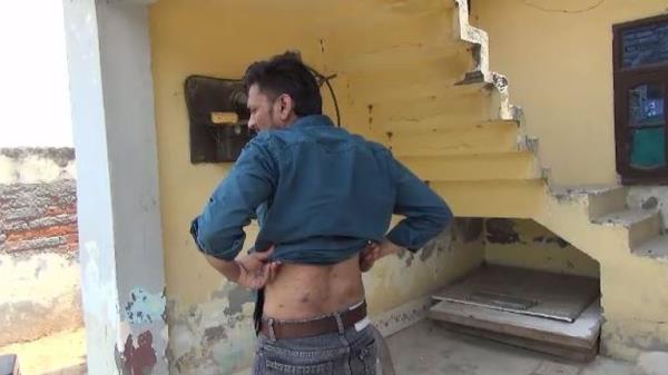 Mukesh, 22, shows injuries he claims were inflicted in a Russian prison