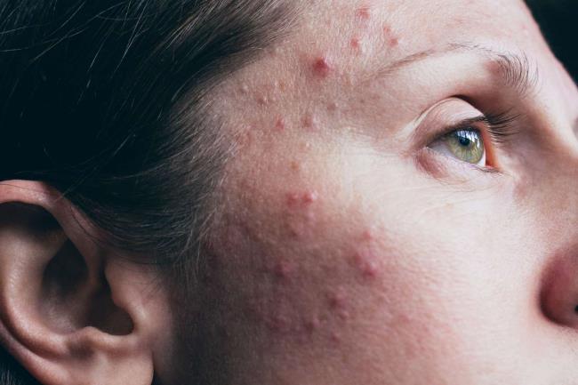 60-facts-a<em></em>bout-acne