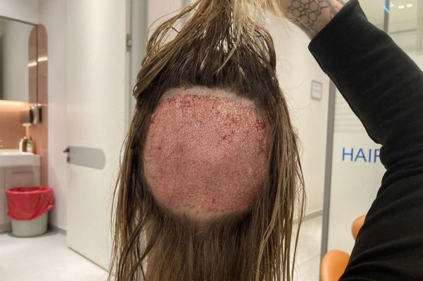 Surgeons used hair from the back of Tracy's head for the transplant.