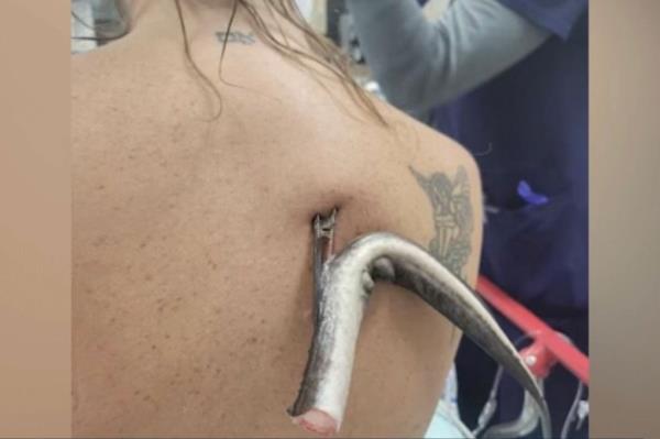 stingray barb in woman's back