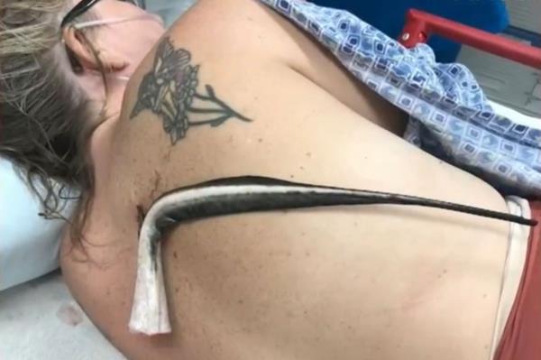 stingray barb in woman's back