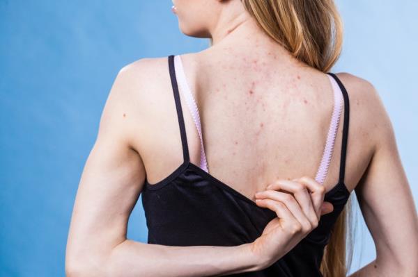 Around 50 million Americans suffer from acne, according to the Cleveland Clinic. Athletes who wear sweaty gym clothes are especially susceptible to unsightly back blemishes, experts say.