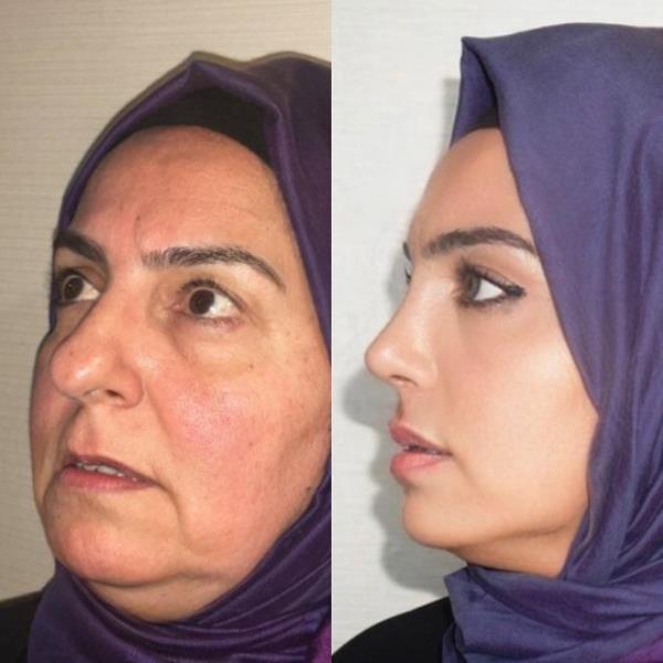 Turkey: Before and after photos of woman after plastic surgery spark co<em></em>ntroversy if it is her https://www.instagram.com/p/CxBLwYhqr84/?img_index=10