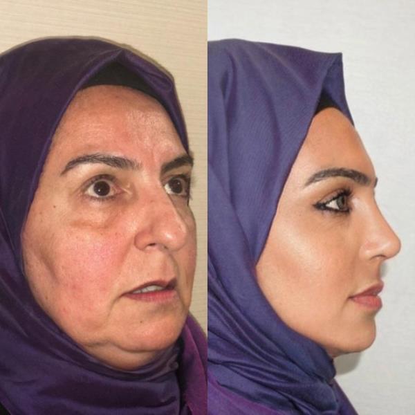 Turkey: Before and after photos of woman after plastic surgery spark co<em></em>ntroversy if it is her https://www.instagram.com/p/CxBLwYhqr84/?img_index=10