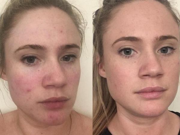 Kayla’s skin at age 27 (left), then three mo<em></em>nths after using Tribe Skincare (right). 