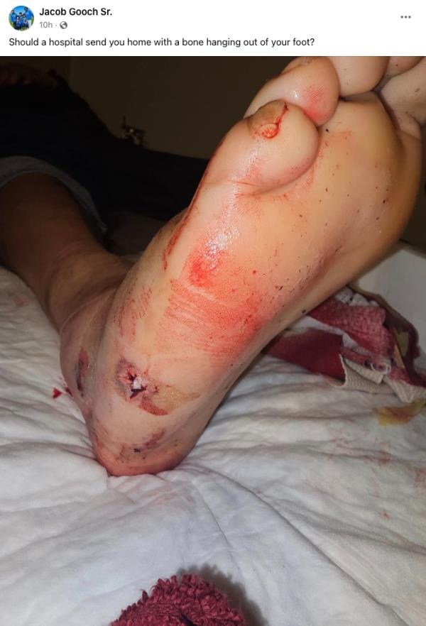 Gooch shared a photo of his injured foot, writing, 