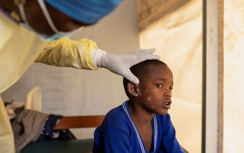 Dr Tresor Wakilo<em></em>ngo checks the skin lesions on the ear of a young Mpox patient