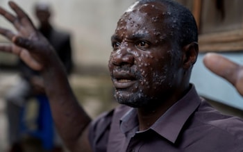 Jean Kakuru Biyambo, 48, a father of six from the Muja internally displaced persons camp, at the Goma general hospital wher<em></em>e he is being treated for Mpox